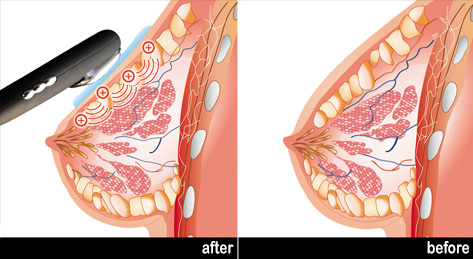 Ilift Firming - Before and after