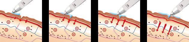 ilift Whitening phase