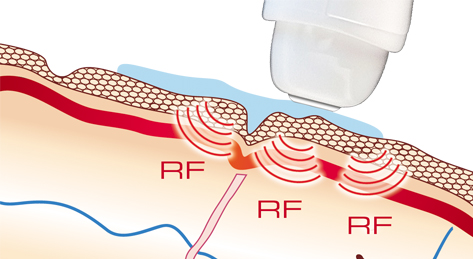 Ilift Radiofrequency - Trattamento